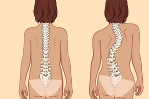 postura eretta e scoliosi con osteocondrosi toracica