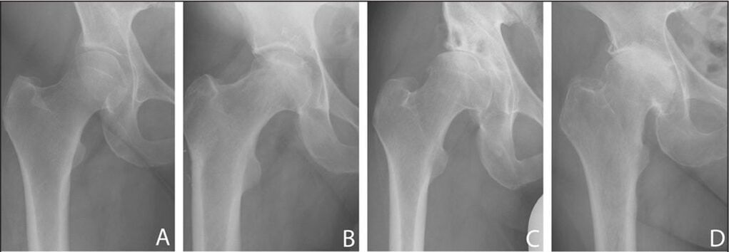 Fasi di sviluppo dell'artrosi dell'articolazione dell'anca alle radiografie