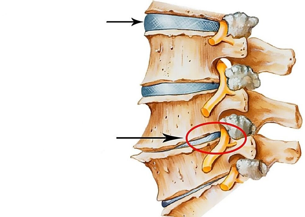 Rappresentazione di dischi intervertebrali sani e deformati
