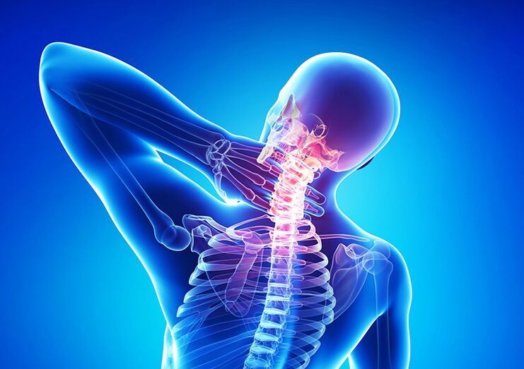 L'osteocondrosi spinale è una malattia che colpisce la cartilagine articolare e le vertebre.