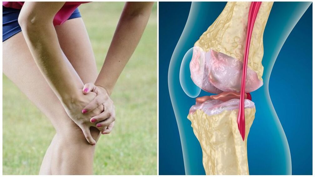 Sintomi dell'osteoartrosi