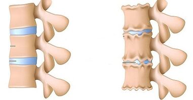 Come riconoscere la presenza di osteocondosi della colonna lombare