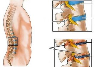 Le cause dell'osteocondosi della colonna lombare