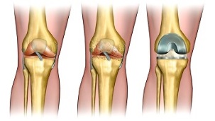 Endoprotesi per l'osteoartrosi dell'articolazione del ginocchio
