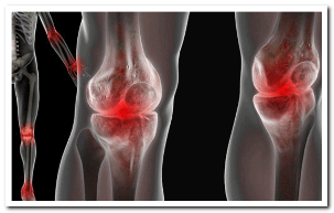 Sintomi dell'osteoartrite