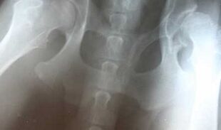 Sintomi e trattamento dell'osteoartrosi dell'anca